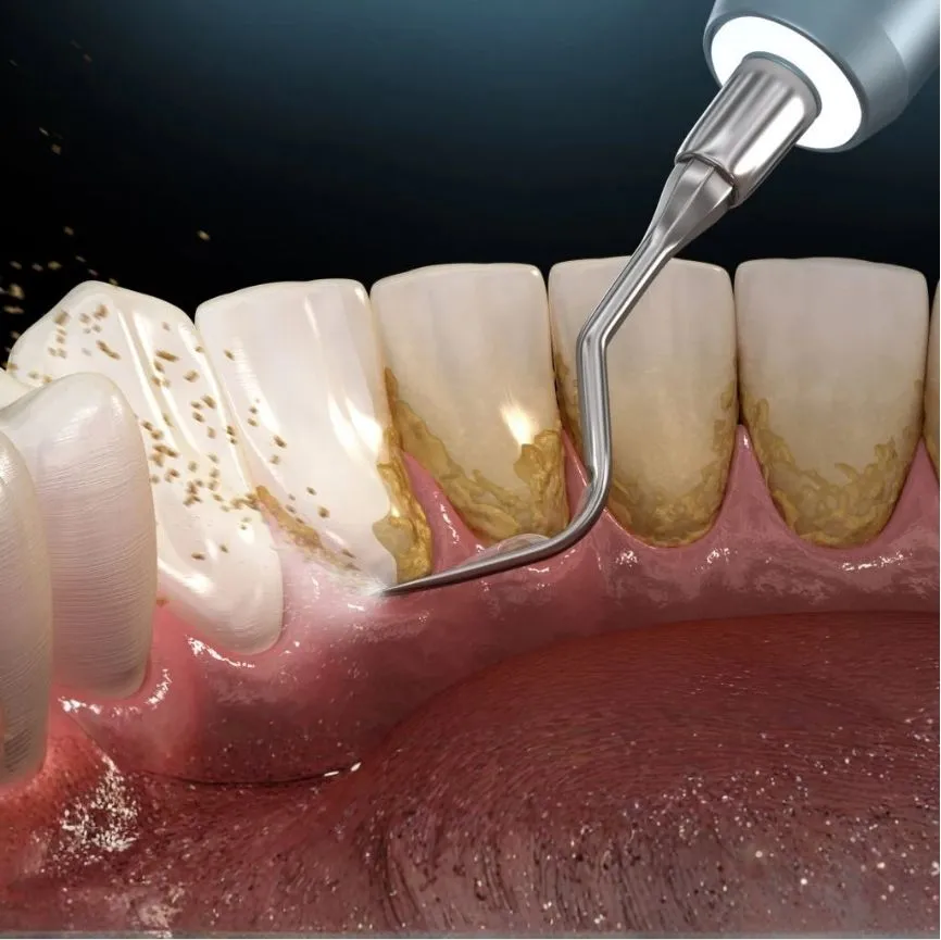 Full mouth cleaning service