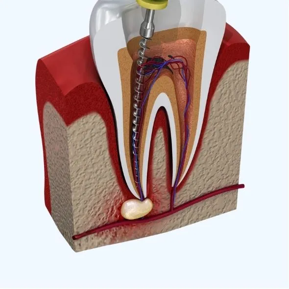Root Canal Treatment RTC service