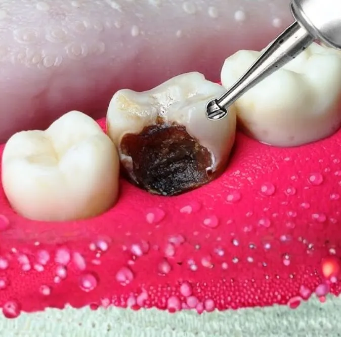 teeth restoration service