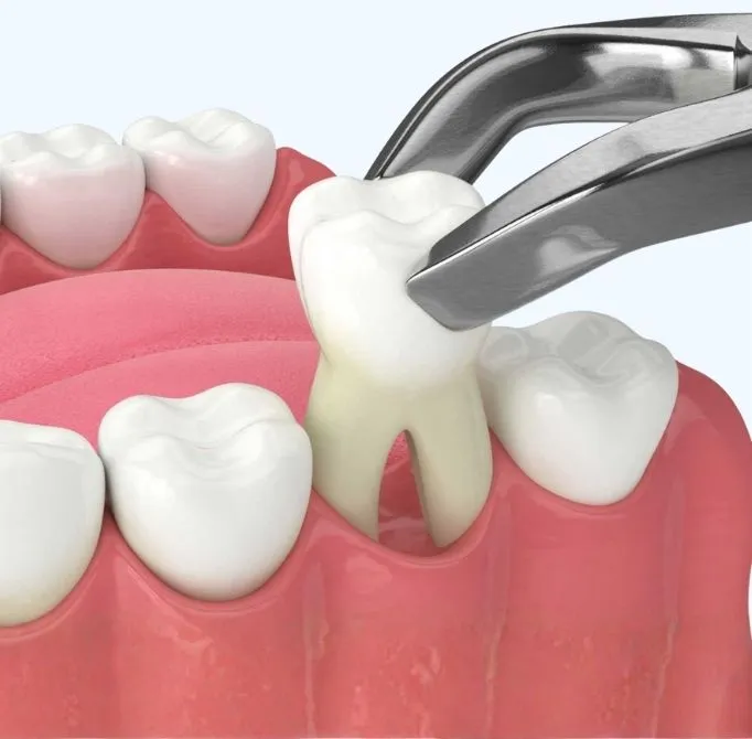 tooth extraction service